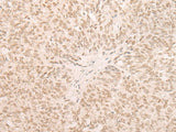 Immunohistochemistry of paraffin-embedded Human ovarian cancer tissue using EIF4A3 Polyclonal Antibody at dilution of 1:35(×200)
