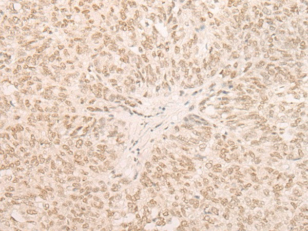 Immunohistochemistry of paraffin-embedded Human ovarian cancer tissue using EIF4A3 Polyclonal Antibody at dilution of 1:35(×200)
