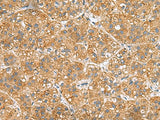 Immunohistochemistry of paraffin-embedded Human liver cancer tissue using PPM1M Polyclonal Antibody at dilution of 1:50(×200)
