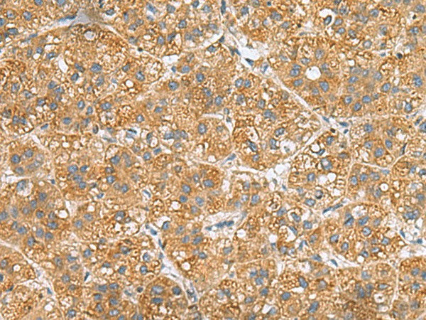 Immunohistochemistry of paraffin-embedded Human liver cancer tissue using PPM1M Polyclonal Antibody at dilution of 1:50(×200)