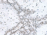 Immunohistochemistry of paraffin-embedded Human breast cancer tissue using PCLAF Polyclonal Antibody at dilution of 1:80(×200)