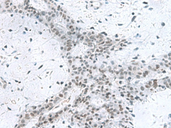 Immunohistochemistry of paraffin-embedded Human breast cancer tissue using PCLAF Polyclonal Antibody at dilution of 1:80(×200)