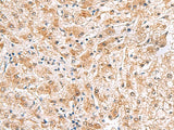 Immunohistochemistry of paraffin-embedded Human liver cancer tissue using PDCL2 Polyclonal Antibody at dilution of 1:65(×200)