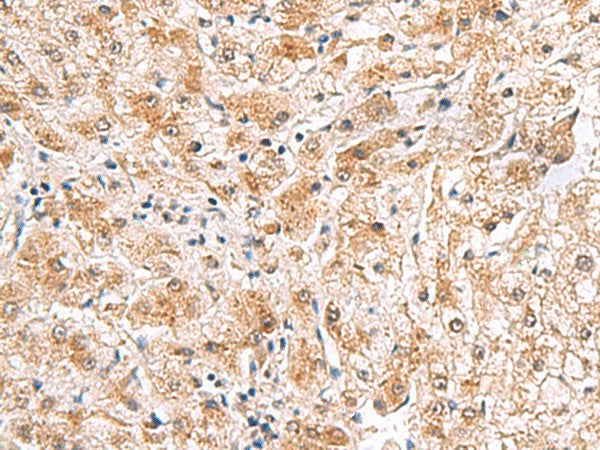 Immunohistochemistry of paraffin-embedded Human liver cancer tissue using PDCL2 Polyclonal Antibody at dilution of 1:65(×200)