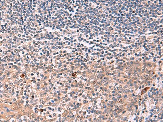 Immunohistochemistry of paraffin-embedded Human tonsil tissue using IFNA1:IFNA13 Polyclonal Antibody at dilution of 1:35(×200)