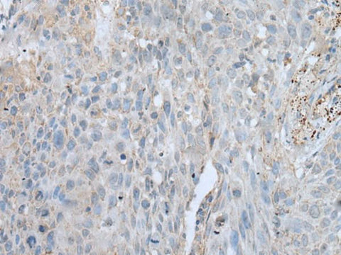 Immunohistochemistry of paraffin-embedded Human lung cancer tissue using VWA2 Polyclonal Antibody at dilution of 1:45(×200)