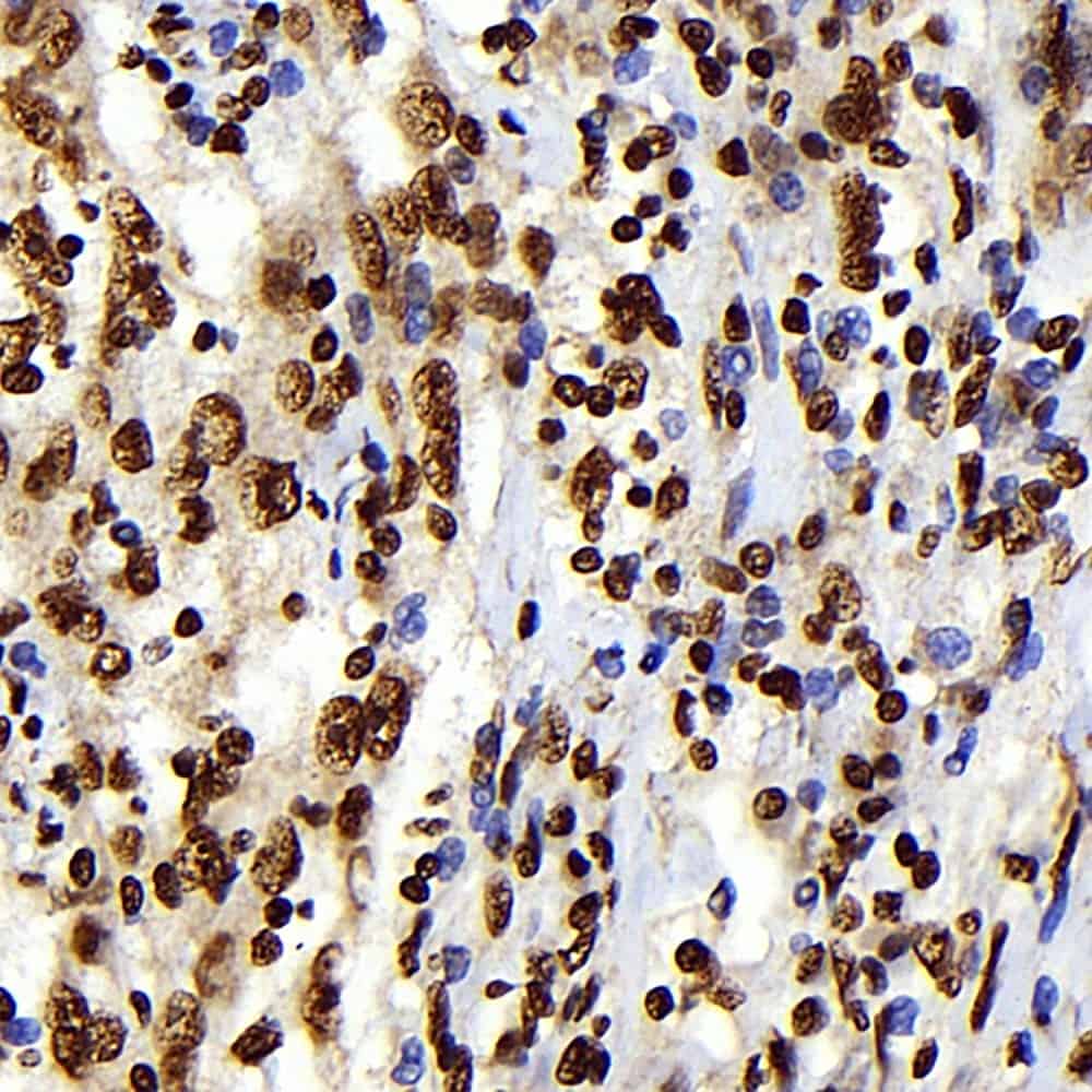 Immunohistochemistry analysis of paraffin-embedded human lymphoma using S100A4 Monoclonal Antibody at dilution of 1:300.