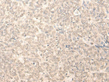 Immunohistochemistry of paraffin-embedded Human ovarian cancer tissue using RUVBL2 Polyclonal Antibody at dilution of 1:25(×200)