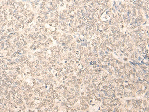 Immunohistochemistry of paraffin-embedded Human ovarian cancer tissue using RUVBL2 Polyclonal Antibody at dilution of 1:25(×200)