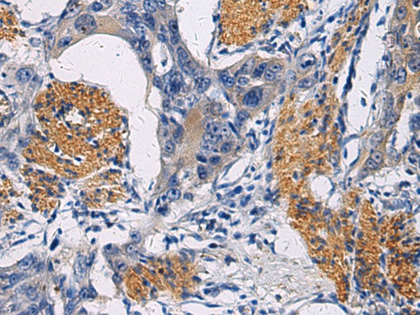 Immunohistochemistry of paraffin-embedded Human esophagus cancer tissue using FAM20C Polyclonal Antibody at dilution of 1:45(×200)