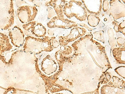 Immunohistochemistry of paraffin-embedded Human thyroid cancer tissue using JPT1 Polyclonal Antibody at dilution of 1:35(×200)