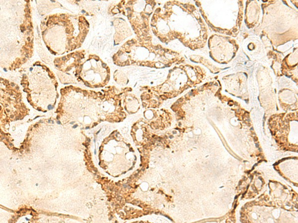 Immunohistochemistry of paraffin-embedded Human thyroid cancer tissue using JPT1 Polyclonal Antibody at dilution of 1:35(×200)
