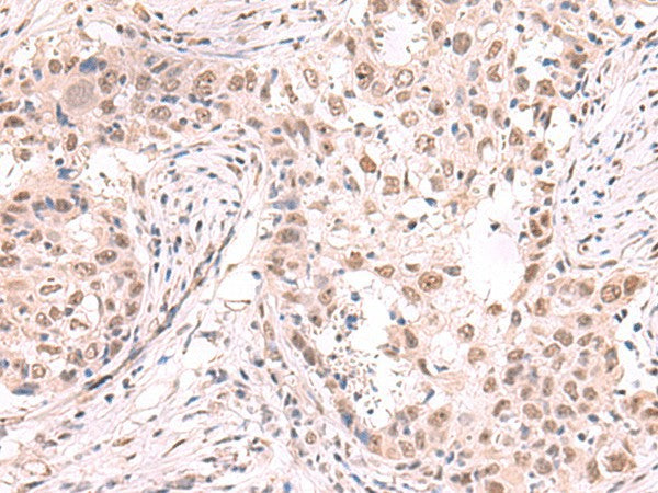 Immunohistochemistry of paraffin-embedded Human esophagus cancer tissue using ZNF559 Polyclonal Antibody at dilution of 1:80(×200)