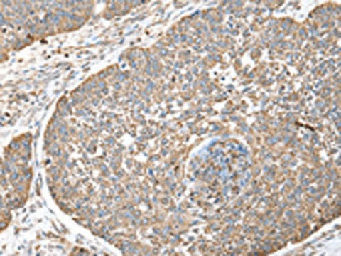 Immunohistochemistry of paraffin-embedded Human lung cancer tissue using DPH7 Polyclonal Antibody at dilution of 1:40(×200)