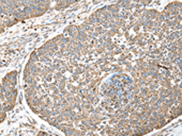 Immunohistochemistry of paraffin-embedded Human lung cancer tissue using DPH7 Polyclonal Antibody at dilution of 1:40(×200)