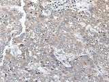 Immunohistochemistry of paraffin-embedded Human liver cancer tissue using BRMS1L Polyclonal Antibody at dilution of 1:45(×200)