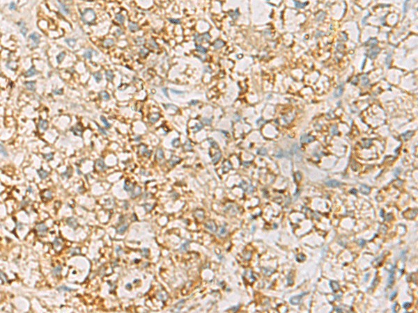 Immunohistochemistry of paraffin-embedded Human liver cancer tissue using HLA-DQB2 Polyclonal Antibody at dilution of 1:70(×200)