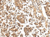 Immunohistochemistry of paraffin-embedded Human breast cancer tissue using NHLRC2 Polyclonal Antibody at dilution of 1:40(×200)