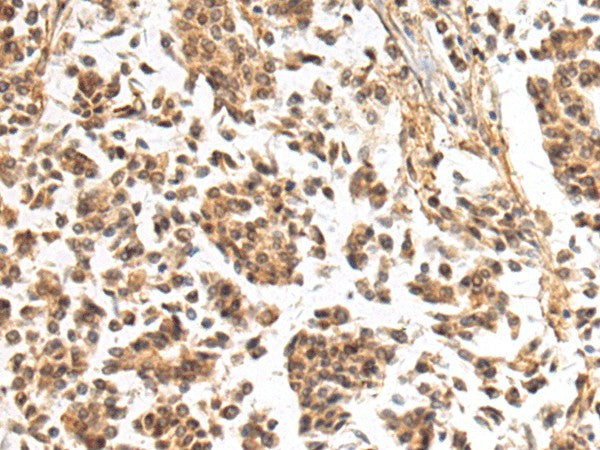 Immunohistochemistry of paraffin-embedded Human breast cancer tissue using NHLRC2 Polyclonal Antibody at dilution of 1:40(×200)