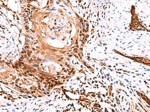 Immunohistochemistry of paraffin-embedded Human esophagus cancer tissue using TSEN2 Polyclonal Antibody at dilution of 1:60(×200)