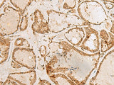Immunohistochemistry of paraffin-embedded Human thyroid cancer tissue using H3F3B Polyclonal Antibody at dilution of 1:40(×200)