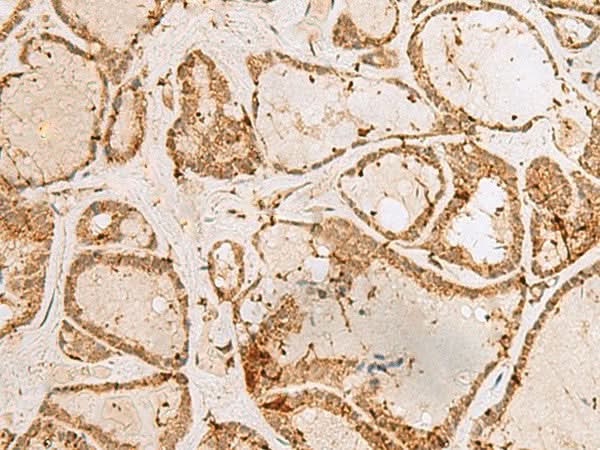 Immunohistochemistry of paraffin-embedded Human thyroid cancer tissue using H3F3B Polyclonal Antibody at dilution of 1:40(×200)