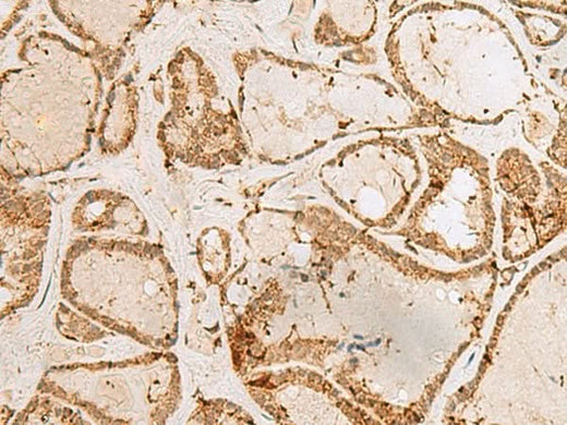 Immunohistochemistry of paraffin-embedded Human thyroid cancer tissue using H3F3B Polyclonal Antibody at dilution of 1:40(×200)
