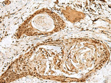 Immunohistochemistry of paraffin-embedded Human esophagus cancer tissue using SNAPC1 Polyclonal Antibody at dilution of 1:40(×200)