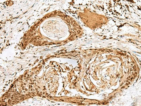 Immunohistochemistry of paraffin-embedded Human esophagus cancer tissue using SNAPC1 Polyclonal Antibody at dilution of 1:40(×200)