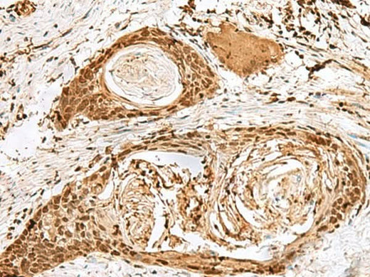 Immunohistochemistry of paraffin-embedded Human esophagus cancer tissue using SNAPC1 Polyclonal Antibody at dilution of 1:40(×200)