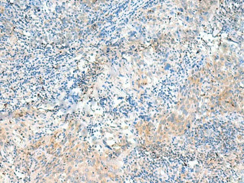 Immunohistochemistry of paraffin-embedded Human cervical cancer tissue using NID2 Polyclonal Antibody at dilution of 1:50(×200)