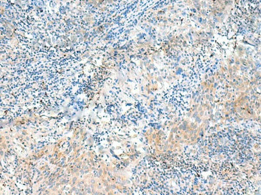 Immunohistochemistry of paraffin-embedded Human cervical cancer tissue using NID2 Polyclonal Antibody at dilution of 1:50(×200)