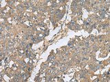 Immunohistochemistry of paraffin-embedded Human liver cancer tissue using EIF1AX Polyclonal Antibody at dilution of 1:65(×200)