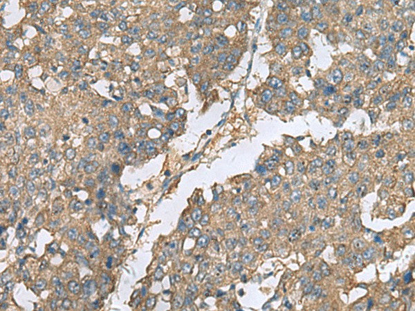Immunohistochemistry of paraffin-embedded Human liver cancer tissue using EIF1AX Polyclonal Antibody at dilution of 1:65(×200)
