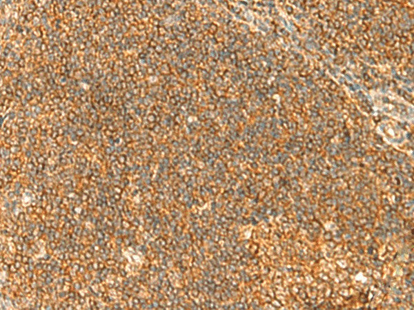 Immunohistochemistry of paraffin-embedded Human tonsil tissue using TBCK Polyclonal Antibody at dilution of 1:40(×200)
