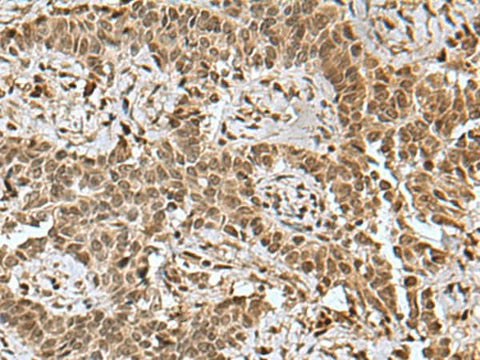 Immunohistochemistry of paraffin-embedded Human ovarian cancer tissue using BCL7B Polyclonal Antibody at dilution of 1:85(×200)