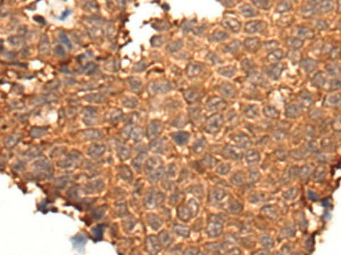 Immunohistochemistry of paraffin-embedded Human ovarian cancer tissue using HOXD8 Polyclonal Antibody at dilution of 1:40(×200)