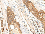 Immunohistochemistry of paraffin-embedded Human esophagus cancer tissue using CYYR1 Polyclonal Antibody at dilution of 1:85(×200)