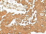 Immunohistochemistry of paraffin-embedded Human lung cancer tissue using SMOC1 Polyclonal Antibody at dilution of 1:35(×200)
