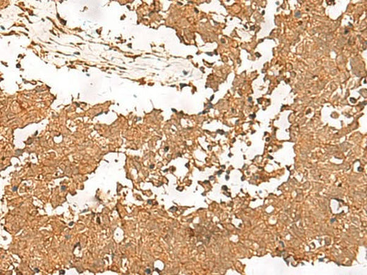 Immunohistochemistry of paraffin-embedded Human lung cancer tissue using SMOC1 Polyclonal Antibody at dilution of 1:35(×200)