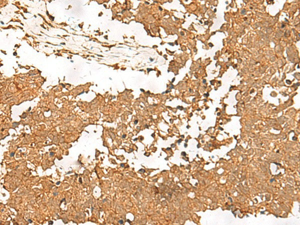 Immunohistochemistry of paraffin-embedded Human lung cancer tissue using SMOC1 Polyclonal Antibody at dilution of 1:35(×200)