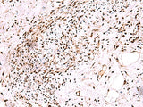 Immunohistochemistry of paraffin-embedded Human cervical cancer tissue using CDKN1B Polyclonal Antibody at dilution of 1:75(×200)