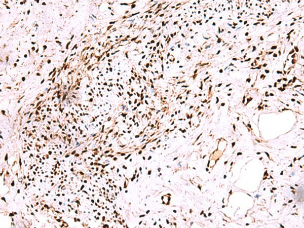 Immunohistochemistry of paraffin-embedded Human cervical cancer tissue using CDKN1B Polyclonal Antibody at dilution of 1:75(×200)