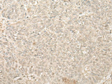 Immunohistochemistry of paraffin-embedded Human ovarian cancer tissue using FYTTD1 Polyclonal Antibody at dilution of 1:25(×200)