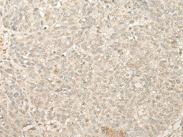 Immunohistochemistry of paraffin-embedded Human ovarian cancer tissue using FYTTD1 Polyclonal Antibody at dilution of 1:25(×200)