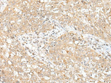Immunohistochemistry of paraffin-embedded Human esophagus cancer tissue using CHRNB2 Polyclonal Antibody at dilution of 1:50(×200)