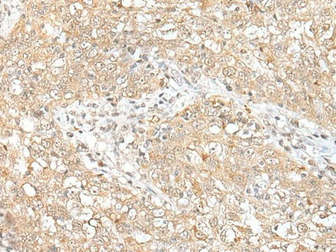 Immunohistochemistry of paraffin-embedded Human esophagus cancer tissue using CHRNB2 Polyclonal Antibody at dilution of 1:50(×200)