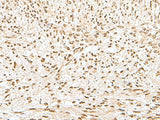 Immunohistochemistry of paraffin-embedded Human liver cancer tissue using GTF2A2 Polyclonal Antibody at dilution of 1:30(×200)
