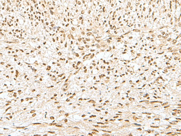 Immunohistochemistry of paraffin-embedded Human liver cancer tissue using GTF2A2 Polyclonal Antibody at dilution of 1:30(×200)