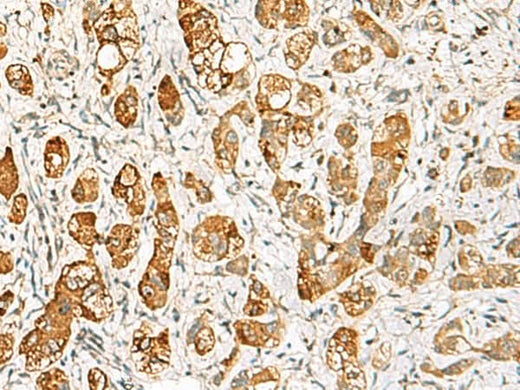 Immunohistochemistry of paraffin-embedded Human liver cancer tissue using RIMS3 Polyclonal Antibody at dilution of 1:60(×200)